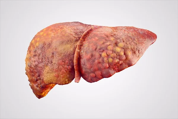 Cirrhosis