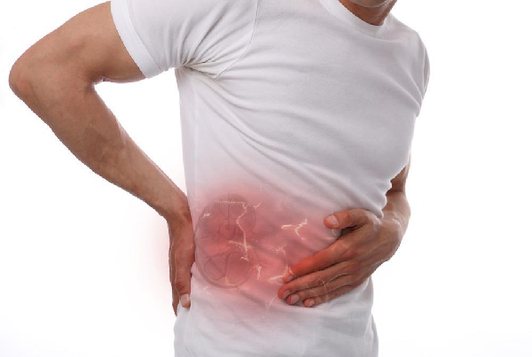 Kidney Stones